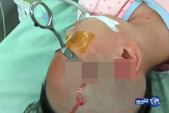 بالصور.. إيراني يطعن ابنته بمقص في رأسها