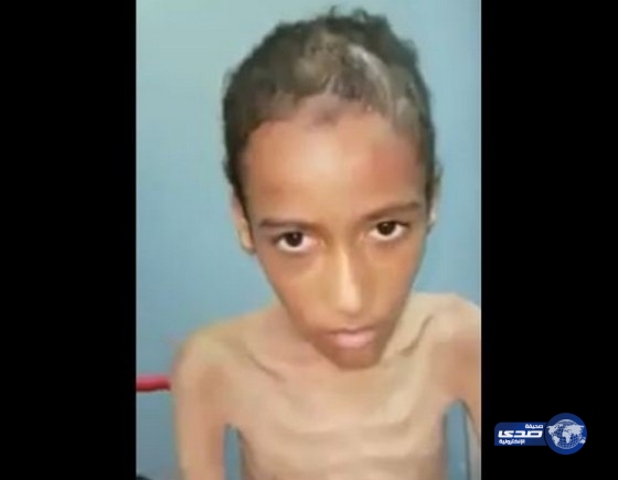 وزارة العمل والتنمية الاجتماعية تكشف عن  تعرض طفل خيبر  للتجويع والضرب