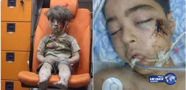 وفاة شقيق &#8220;الطفل عمران&#8221;.. بعد إصابته في نفس الغارة التي أصابت منزل أسرتهما في حلب