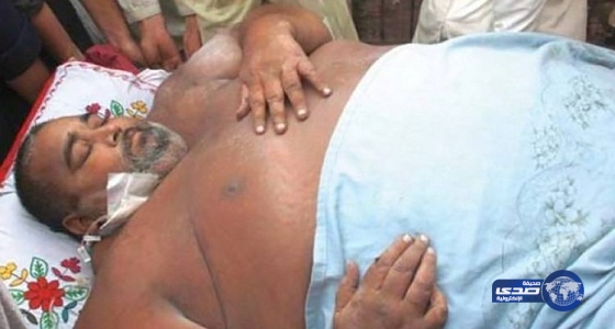 الأطباء يعجزون عن تشخيص حالة باكستاني وزنه 270 كيلو