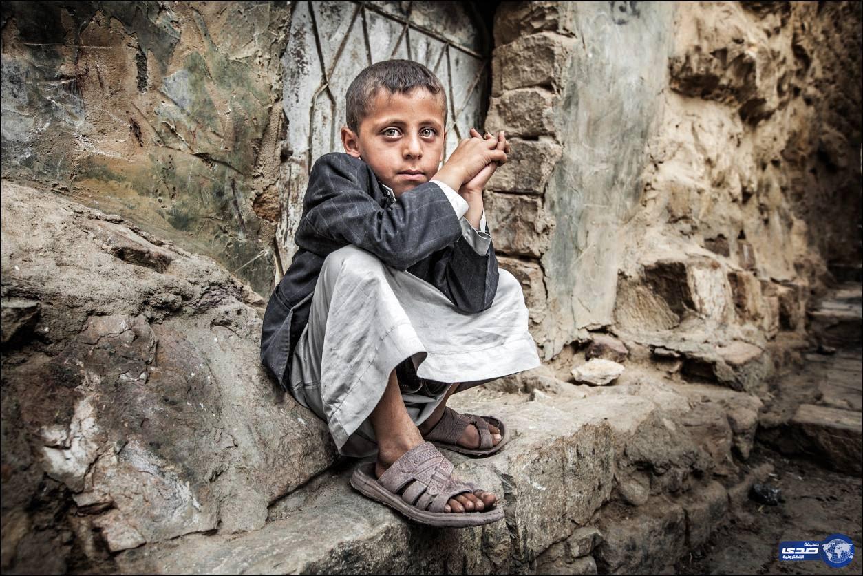 الأمم المتحدة تحذر من ارتفاع معدلات سوء التغذية بين الأطفال في اليمن
