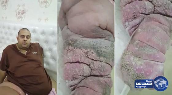 بالفيديو..مريض بـ«داء الفيل» يناشد الأمير محمد بن سلمان بالتدخل لعلاجه