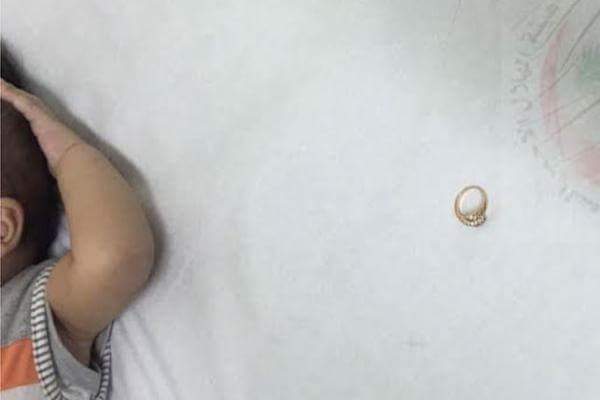 استخراج خاتم تسبب في اختناق طفل بالقصيم