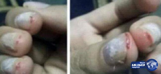 معلمة تقتلع أظافر طالبة بأحد المدارس الثانوية بالقطيف