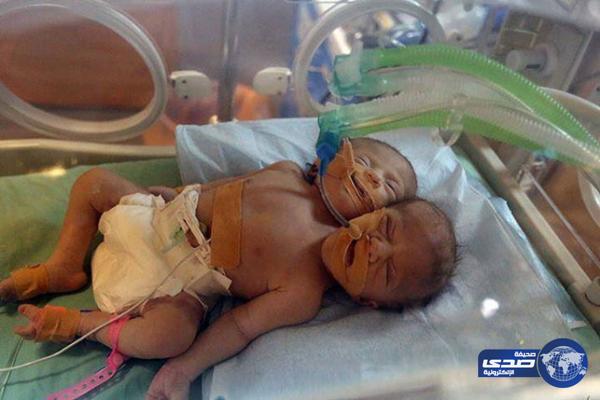 بالصور.. ولادة توأم سيامي برأسين وجسم واحد بغزة
