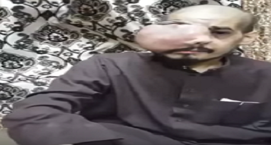 بالفيديو: مواطن يعاني ورماً ضخماً يغطي عينه يناشد ولي ولي العهد إنهاء معاناته