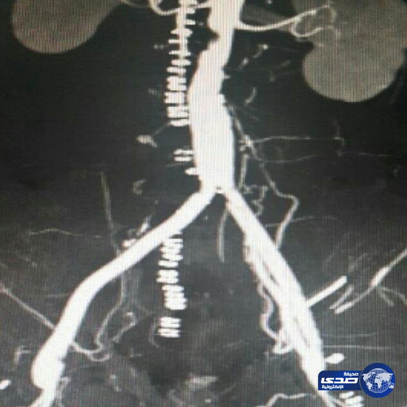 اجراء أول عملية تغيير شريان صناعي بمستشفى الملك فهد بالباحة