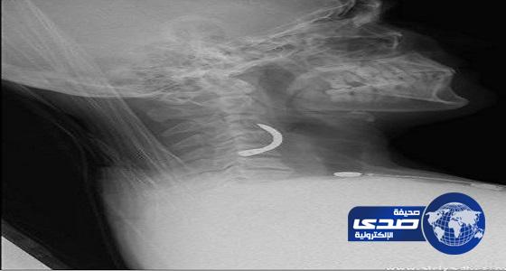 فريق طبي بمدينة الملك سعود الطبية يستخرج مسمارا من رقبة مقيم