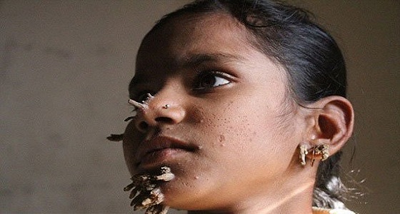 بالصور فتاة تتحول إلي شجرة بسبب مرض نادر ببنجلادش