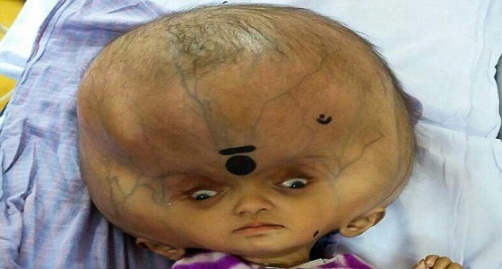 بالصور..سحب سوائل من أكبر رأس طفل في العالم