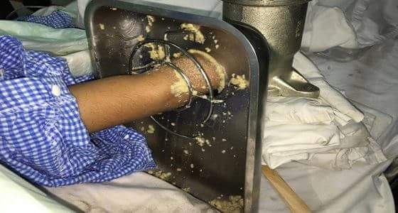 بالصورة..بتر يد طفل بعدما ادخلها في فرامة لحوم في جدة