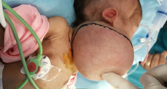 ولادة مكة تجري جراحة معقدة ونادرة لاستئصال ورم لرضيعة