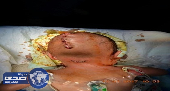 فريق طبي ينقذ طفل رضيع بجراحة نادرة في المخ بمستشفى الملك سلمان