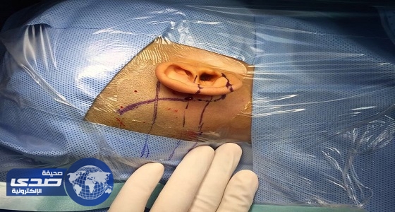 استشاري جراحات الأذن الدقيقه يروى لحظات إنسانية بإعادة السمع لأطفال صم