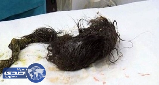 فريق طبي يستخرج كتلة من الشعر داخل معدة فتاة بينبع