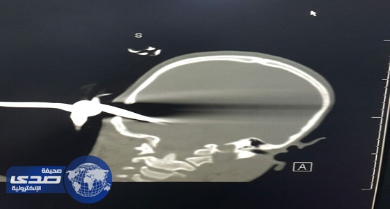 استخراج «زرادية» أخترقت جمجة طفل بتبوك