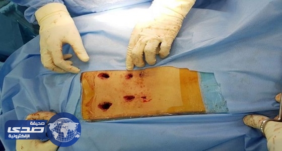 نجاح جراحة نادرة لتثبيت العمود الفقري لأربعينية بالمدينة