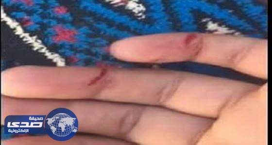 بالفيديو..معلمة تمزق يد طالبة ضربا بمسطرة خشبية في المدينة