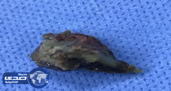 فريق طبي يستخراج «جسم صخري» من أنف طفل بمستشفى القريات