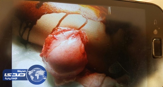 فريق طبي ينقذ حياة شاب تعرض لعدة طعنات متفرقة ببيشة