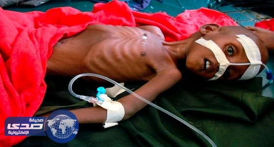موجة جفاف وسوء تغذية تودي بحياة  5 أطفال فى باكستان