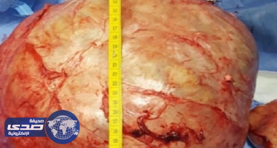 نجاح استئصال ورم خبيث لسيدة سبعينية في المدينة