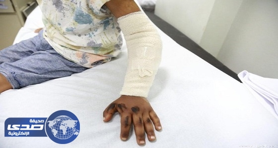 انقاذ يد طفل تعرض لحادث من البتر في سعود الطبية