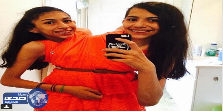 رغم خطورة حالتهما توأم سيامي ترفضان الأنفصال