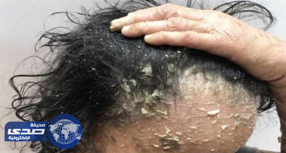 بالفيديو.. 25 الف ريال تكلفة علاج طفلة سعودية مريضة ” بالجلد السمكى ” بالهند