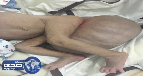 جراحة نادرة لطفل يبلغ من العمر شهراً واحداً والعملية استغرقت 9 ساعات بالرياض