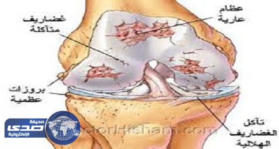 علاج خشونة المفاصل بالخلايا الجذعية غير موثوق ويسبب السرطان