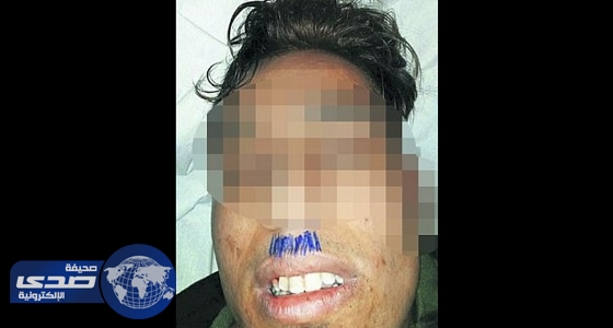 مسعف ألماني يرسم بالقلم الجاف شنب هتلر على وجه مريض لاجئ