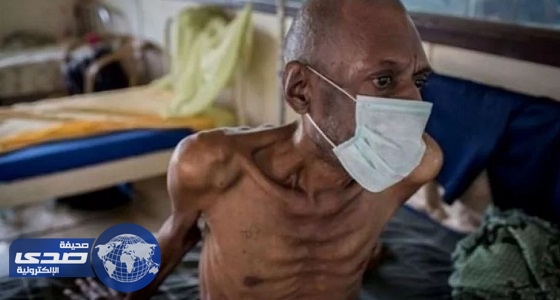 مليشيات الحوثي والمخلوع تستغل «الكوليرا» لتحقيق مكاسب سياسية