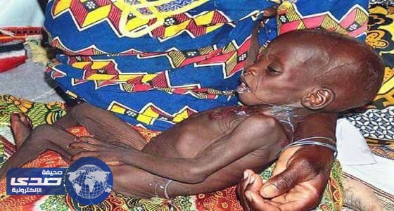 سوء التغذية الحاد يهدد مليون طفل صومالي