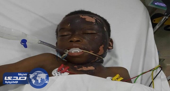 بالصور.. إصابة طفل بحروق خطرة إثر تعرضه لصعقة «ضغط عالي» بجازان