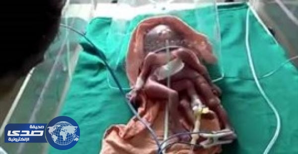 بالفيديو .. ولادة طفلة بـ4 أذرع وأرجل