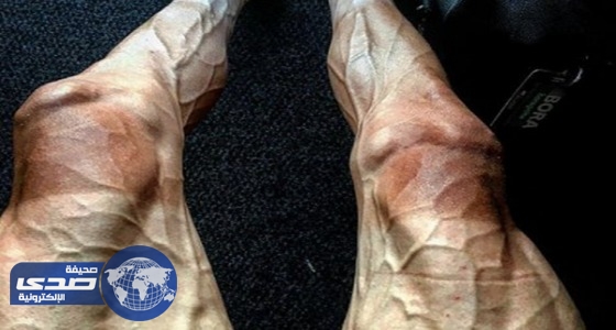 دراج بولندي ينشر صورة خطيرة لساقيه ويكشف أسبابها