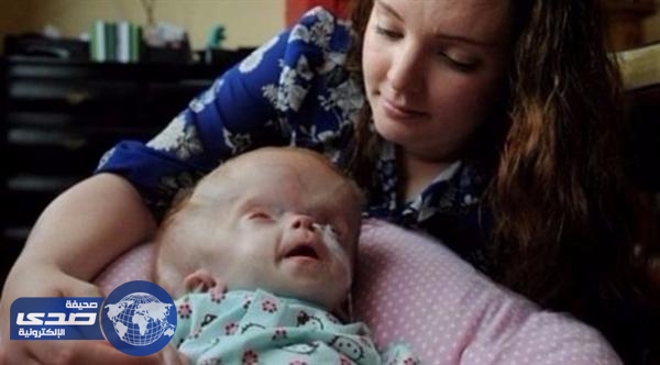 طفلة برأس متضخم تتحدى توقعات الأطباء وتنجو من الموت بأعجوبة