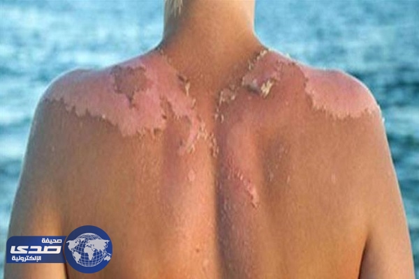 كيف تعالج جلدك المتشقق بعد التعرض للشمس
