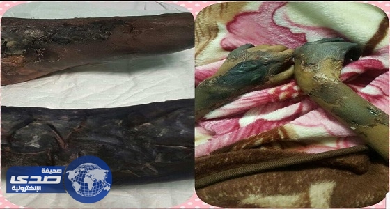 ” الصحة ” : الطفلة المصابة بالجرعات الكيماوية تحظى باهتمام المسؤولين