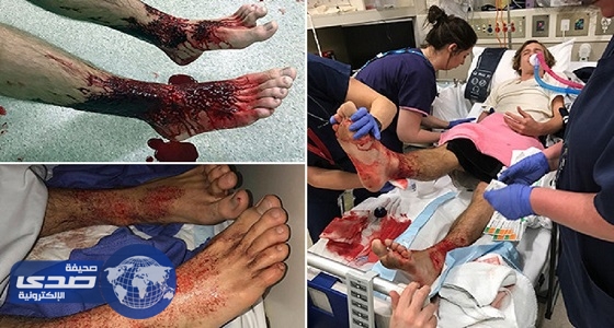 بالفيديو.. آكلات لحوم تُهاجم مراهق وتنبش قدمه