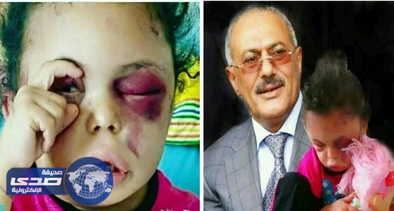 الرئيس المخلوع يتاجر بالمصابين من أطفال اليمن