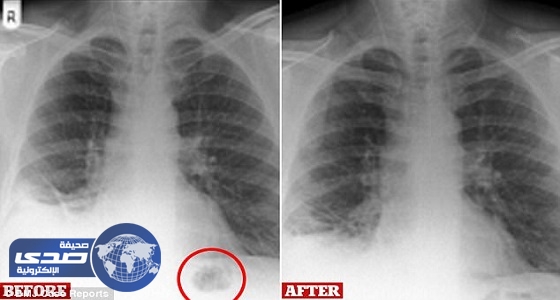 توقع إصابته بالسرطان فاكتشف سر عمره 40 عاما