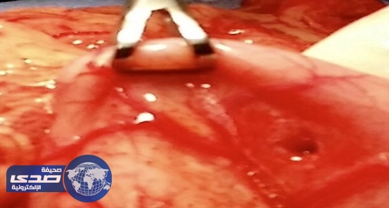 استخراج رصاصة من معدة طفلة بمستشفى الملك عبدالله في بيشة