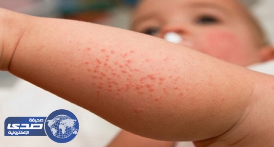 8 أسباب للطفح الجلدي عند الأطفال
