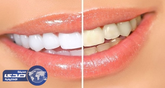كربونات الصوديوم لتبييض الأسنان دون إتلافها