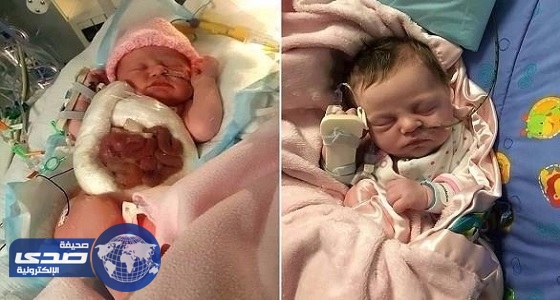 صور صادمة لطفلة ولدت وأمعاؤها خارج جسدها