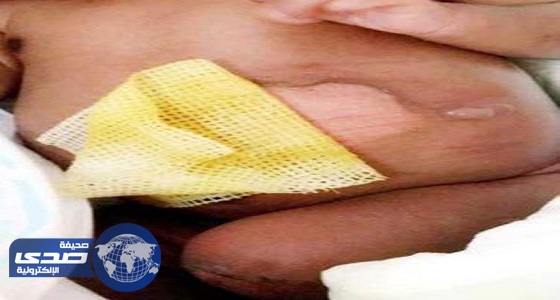 عقوبة هزيلة للممرضة حارقة رضيع بيشة