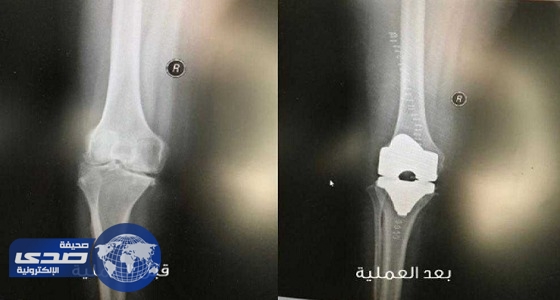 نجاح عملية استبدال مفصل ركبة لمريضة خمسينية في سكاكا