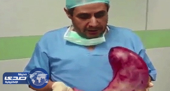 بالفيديو.. طبيب يحمل معدة بشرية ضخمة